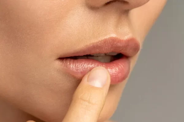5 natural formulas to effectively solve the problem of dry, flaky lips.